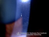 Prominent corneal nerve in a patient with hereditary ichtyosis.